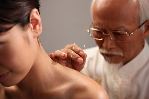 người bệnh có thể điều trị bằng cách châm cứu đau vai gáy
